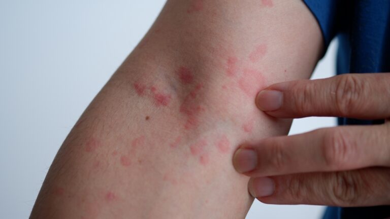 close,up,image,of,skin,texture,suffering,severe,urticaria,or